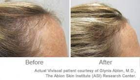However, transportation of oxygen through the blood requires that hemoglobin be Iron Deficiency And Hair Loss Viviscal Healthy Hair Tips
