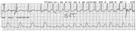 Sveriges television (swedish television), abbreviated as svt, is the public tv broadcaster of sweden. Diagnosis And Management Of Supraventricular Tachycardia 2020 10 16 Relias Media Continuing Medical Education Publishing