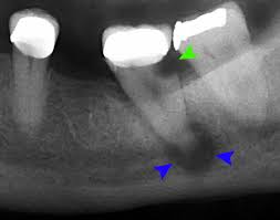 Image result for Periapical Abscess