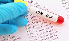 Image result for Herpes Simplex Virus Testing