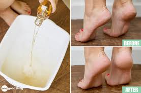 When soaking your calluses, mix chamomile tea or tea tree oil into the water. This Listerine Vinegar Foot Soak Is Magic For Dry Heels