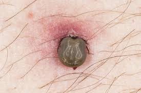 Image result for infected tick bite