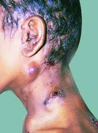 Provocative role in the development of. Tuberculosis Tb Infections Msd Manual Consumer Version