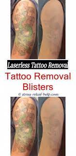 Tattoo Removal Results Blue Tattoo Removal Before And After Tattoo Removal Chattanooga Best Laser For Tattoo Removal Cost Tattoo Removal Results Laser Tattoo