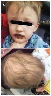 Refractory hypercalcemia owing to vitamin A toxicity in a 4-year-old boy