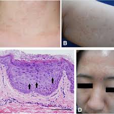 PDF) Two sisters reveal autosomal recessive inheritance of  epidermodysplasia verruciformis: A case report