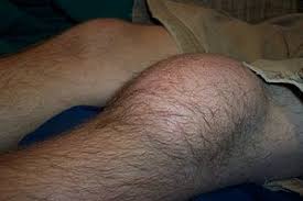 Sharp knee pain symptoms are often a sign of a serious knee injury. Prepatellar Bursitis Wikipedia