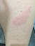 Whooping Cough Vaccine Needle