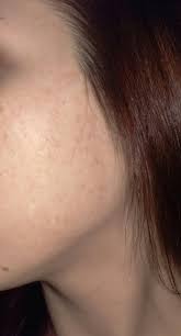 There are also a number of natural ways to lighten spots of skin. Skin Concerns How To Get Rid Of These Red Spots On The Cheek Area They Feel Like Normal Skin Not Acne Scars Routine In Comments Skincareaddiction
