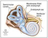 Image of Meniere's Disease