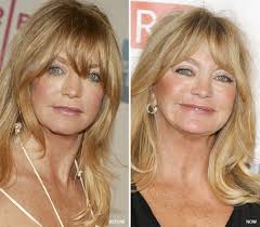 Goldie Hawn Before And After Nose Job Easynip Plastic Surgery Celebrity Plastic Surgery Cosmetic Surgery