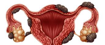 Endometriosis is a full body condition in which cells similar to those in the endometrium, the layer of tissue that normally covers the inside of the uterus, grow outside the uterus. Gen Medicina Endometriose Diagnostico E Tratamento