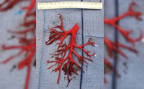 If you have signs or symptoms of a heart attack, pe or stroke, call 911 right away. Man Coughs Up A Giant Blood Clot In The Shape Of His Lung Live Science