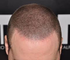 Brushing, touching, styling and sometimes even just laying down on a pillow can be uncomfortable and at times unbearable. Hair Loss Front Of Scalp