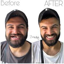 الحمدلله على جزيل النعم ❤️ A patient with a history of an accident which  caused him to lose approximately half of his upper teeth ( From the Central  To the Second Molar ) ..