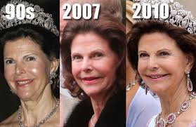 famous-plastic-surgery.blogspot.com: Fillers fit for a Queen?