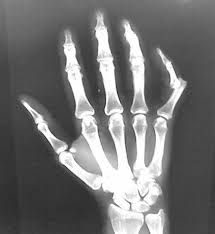 Sometimes, relocating a finger dislocation can be simple and other times it can be very difficult. Finger Dislocation Hand Therapy
