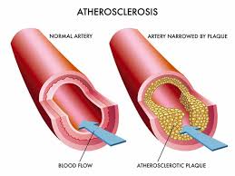The blockage increases your risk of stroke, a medical emergency that occurs when the blood supply to the brain is interrupted or seriously reduced. Clogged Arteries Causes Symptoms Signs Treatment And Prevention