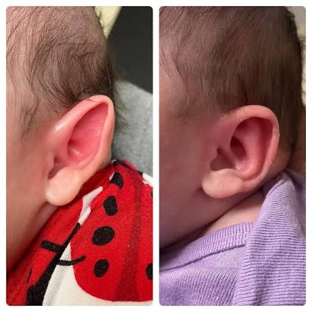 Non-invasive ear molding for a newborn with an ear deformity. Did you know that the ears of a newborn can be molded into a new shape? If your newborn has an ear