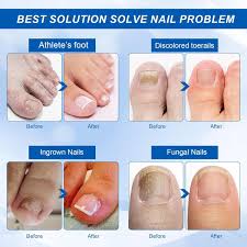 Image result for Paronychia feet