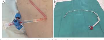 Image result for Small Caliber Chest Tube