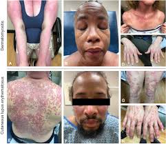 Image result for Dermatomyositis