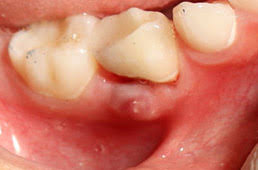 It is caused by a bacterial infection. Toddler Dentist In Peoria Az Pleasant Pediatric Dentistry