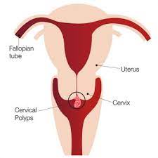 Cervical polyp removal is a simple procedure that can be performed under a local anesthetic. Cervical Polyps Raffles Women S Centre Singapore