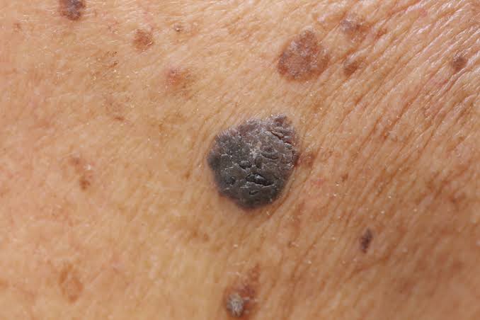 Mole Types and Treatments | U.S. Dermatology Partners