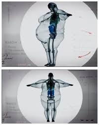 Effect Of Obesity On The Skeleton Food Nairaland Obese People Obesity Body Health