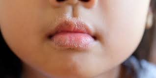 Hilang sudah akal sehatku setelah bibirku bersentuhan dengan bibirnya yang tipis dan indah itu. Bibir Pecah Pecah Dan Mulut Kering Itu Tanda Dermatitis