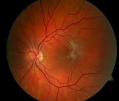 This care sheet gives you a general idea about how long it will take for you to recover. Vitrectomy The American Society Of Retina Specialists