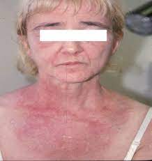 Approaches to complex therapy of women's diffusive alopecia with homeopathic preparation and special cosmetic substances. Dermatomyositis Dermatology Advisor