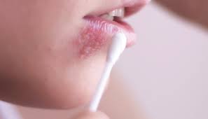 Cold sores (oral herpes, herpes labialis, nongenital herpes simplex infections). Preventing The Spread Of Herpes Simplex Type 1 Dimensions Of Dental Hygiene