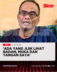 ICYMI Dipandang jijik oleh sesetengah pihak, malah ada yang menyangka  dirinya menghidap penyakit berjangkit. Artikel:  https://www.sinarharian.com.my/article/763999/edisi/melaka-ns/ada-yang-jijik-lihat-badan-muka-dan-tangan-saya  #SinarHarian ...