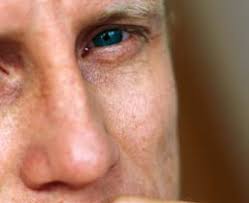 Trias: Multiple Sklerose