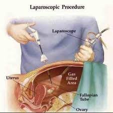 Does insurance cover laparoscopy in india. Best Laparoscopic Gynaecologist In India