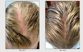 Learn how it's done, health risks, safety tips, and how to take care of your skin afterward. Loss And Regrowth Progress Pictures Treatment Timeline And Details Shedding Health Effects Hairlosstalk Forums