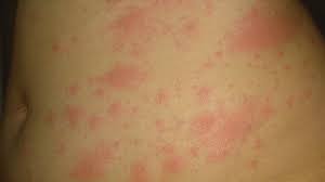 Coronavirus Covid Toe And Other Rashes Puzzle Doctors Bbc News
