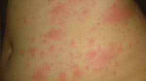 Be on the lookout for the following symptoms in your child (and act quickly if you notice them): Coronavirus Covid Toe And Other Rashes Puzzle Doctors Bbc News