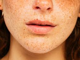 Image result for Freckled skin