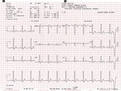 Ecg Interpretation How To Read An Electrocardiogram Usa Medical And Surgical Supplies