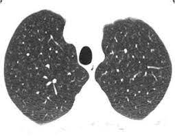 Patients with rbild or dip should receive appropriate smoking cessation advice and treatment. Rbild Hrct At The Level Of The Upper Lobes Exhibits An Ill Defined Download Scientific Diagram