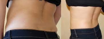 Fett weg spritze vorher nachher bilder sind stets zu empfehlen, um die veränderung zu sehen. Fett Weg Spritze Oder Lipolyse Der Minimal Invasive Weg Um Fettpolster Loszuwerden Die Beautybloggerin