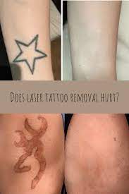 Does Tattoo Removal Leave A Scar Tattooglee Tattoo Removal Tattoo Removal Cost Tattoos