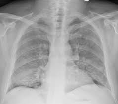 Chest Radiograph Chest X Ray Showing Bilateral Airspace Disease Download Scientific Diagram