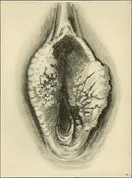 Image result for Vulvar Cancer