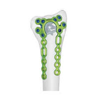 Distal Dorsal Radial π Locking Plate,Medical Device ...
