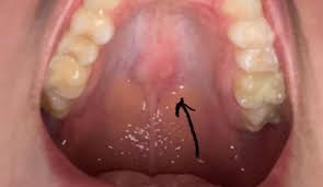 Image result for Canker sores symptoms roof of the mouth