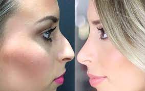 Helena coelho deu à luz a primeira filha a 10 de abril e 11 depois já estava de volta ao trabalho, tendo deixado íris entregue aos cuidados do pai, paulo teixeira. Clinica Fmr Clinica Fmr Helena Coelho Rinolastia